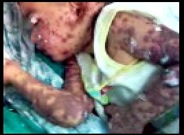 child with symptoms of sjs